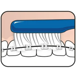 TePe Implantaat/orthodontieborstel (1 stuk)